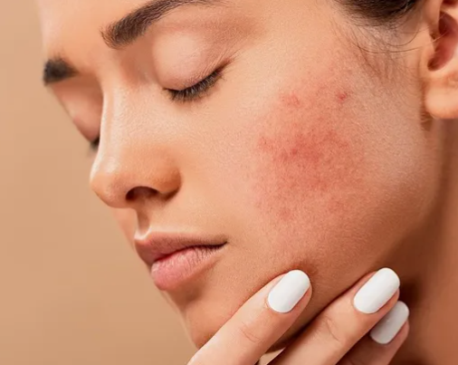 Hands applying gentle moisturizer for sensitive skin